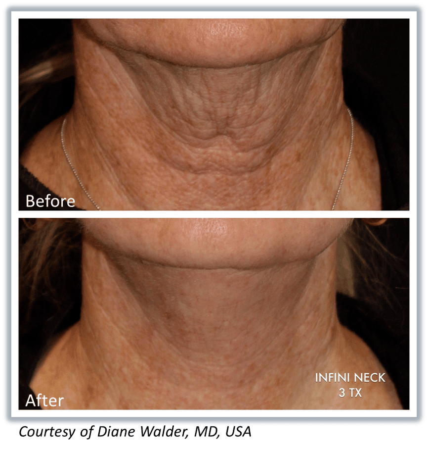 skin tightening to the neck with the infini laser