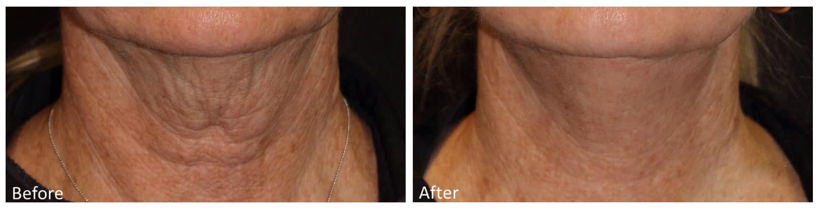 patient before and after results with the collagen facial near joliet