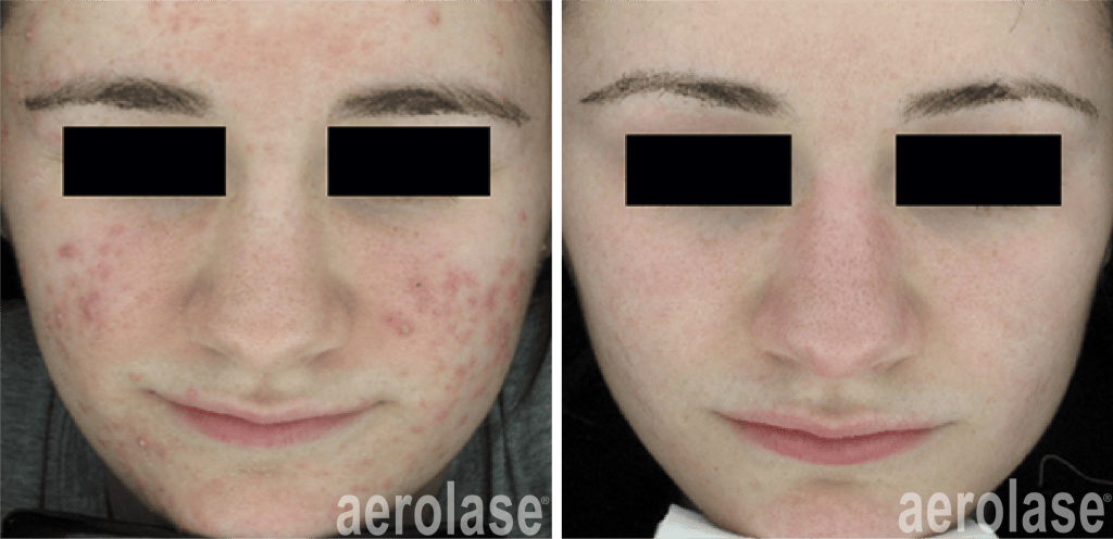 neoclear acne laser treatment