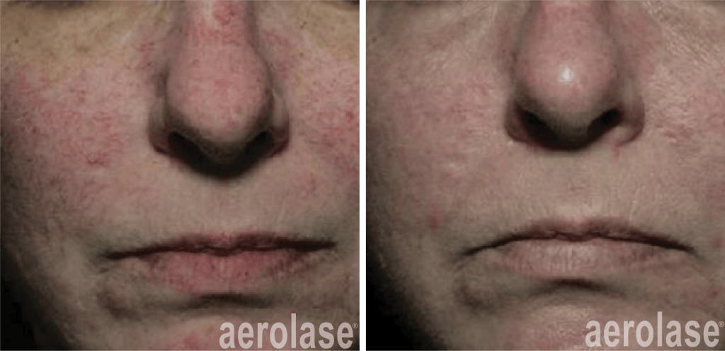 Rosacea Treatment with Aerolase NeoSkin Laser Medspa