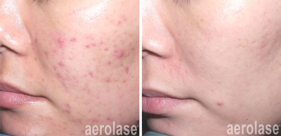 Acne and Acne Scarring Revision Treatment