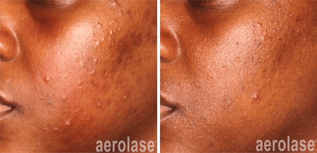 Aerolase Before and After with Patient Michelle Henry