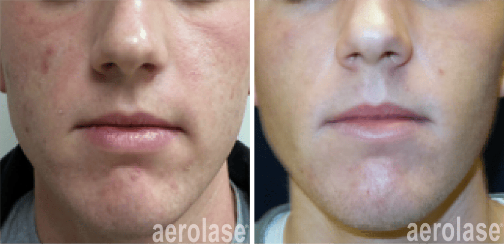 Acne Scars Laser Skin Rejuvenation Joliet Illinois