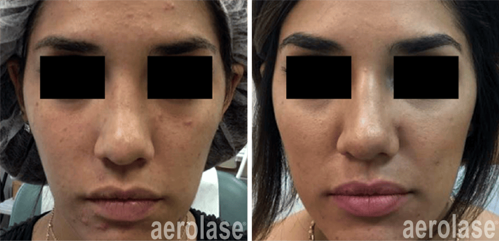 Aerolase Laser Skin Rejuvenation Joliet for Acne