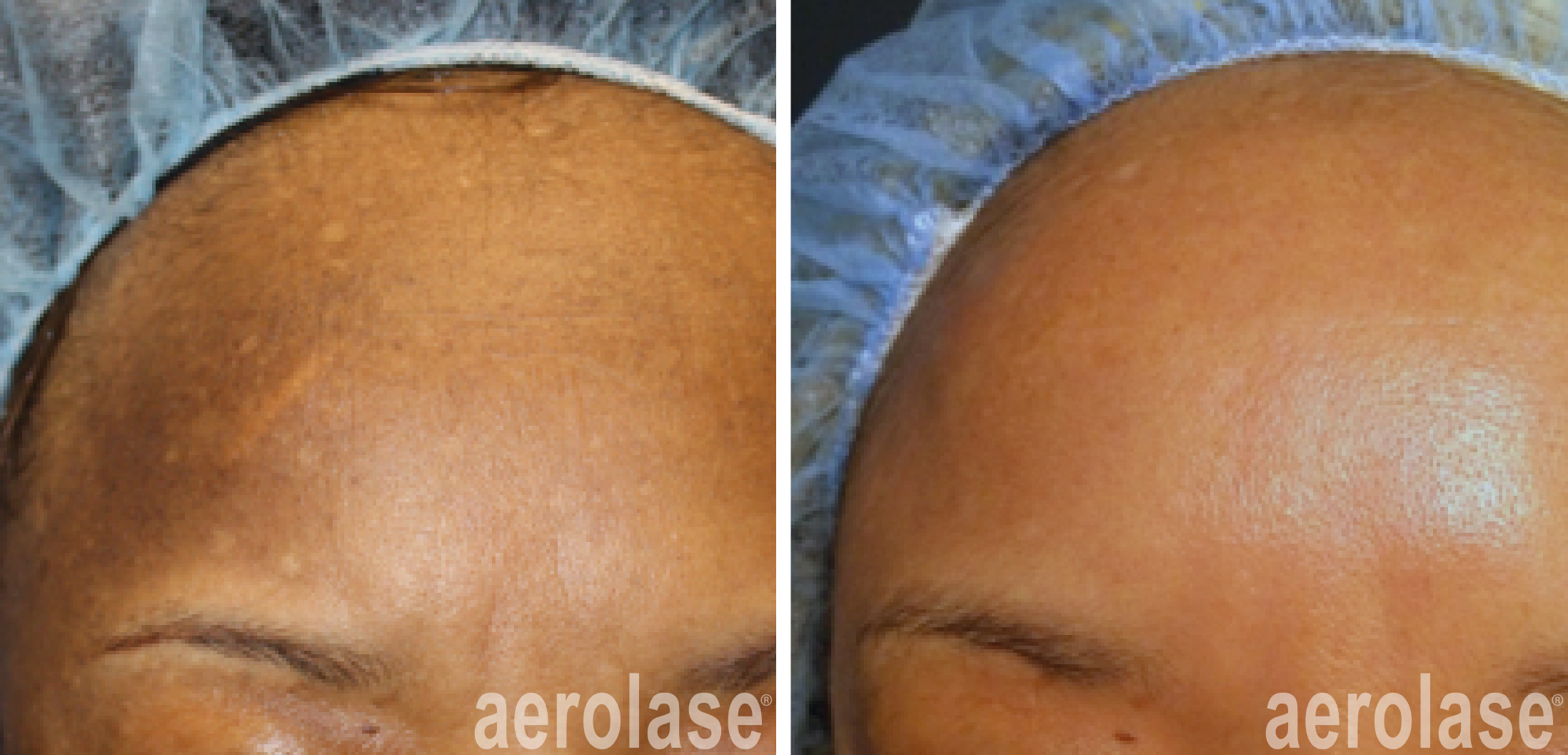 melasma laser treatment