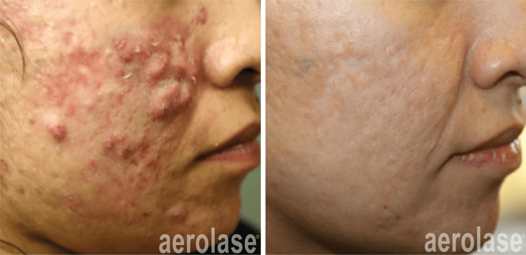 Acne Treatment Plainfield Illinois