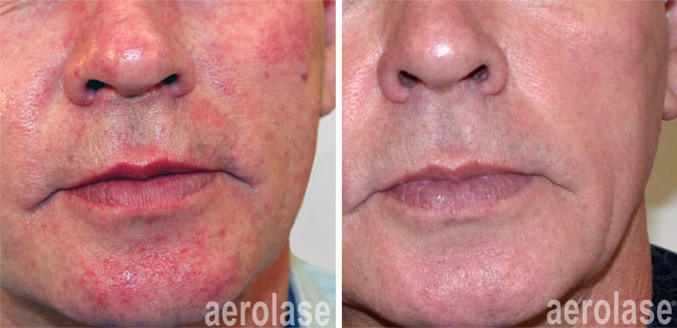 clearing rosacea with aerolase laser