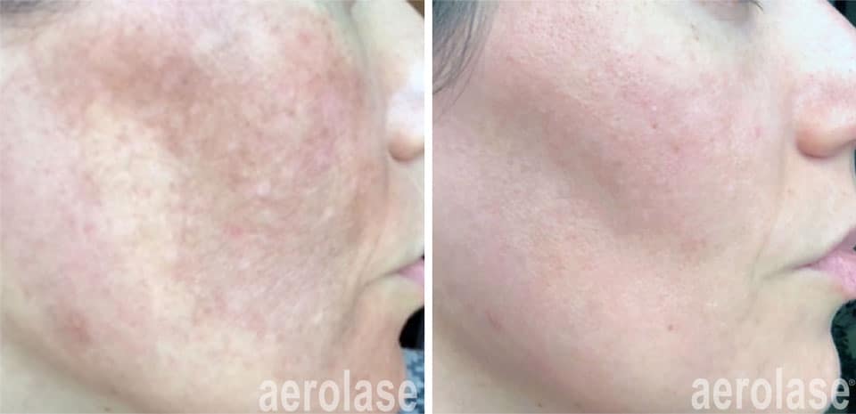 professional melasma treatment