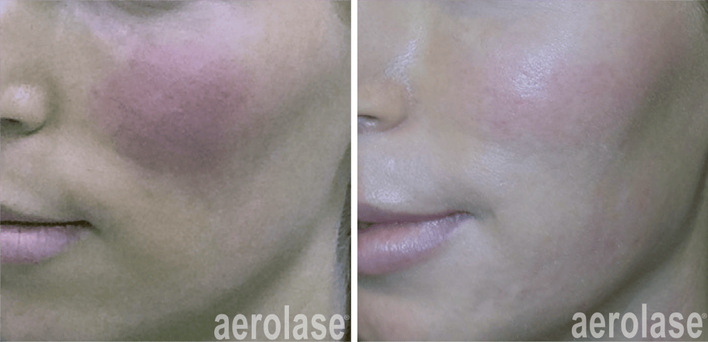 rosacea laser therapy with the aerolase neoskin