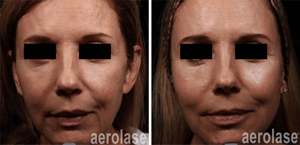 patient with fillers combined with aerolase laser skin therapy