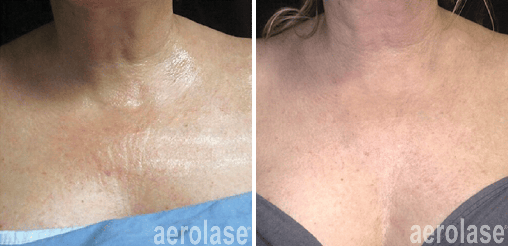laser treatment for neck tightening