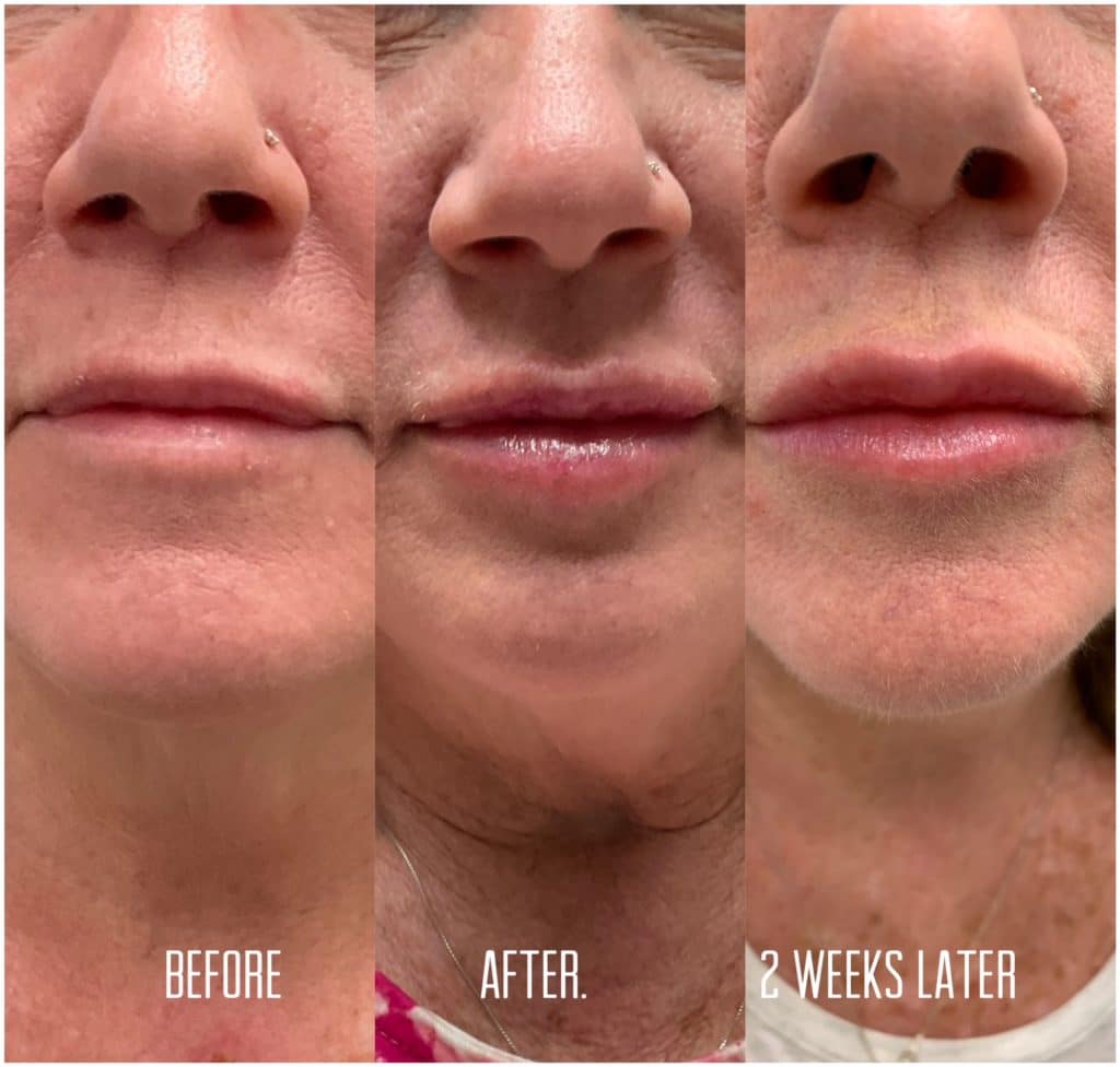 restylane kysse lip filler