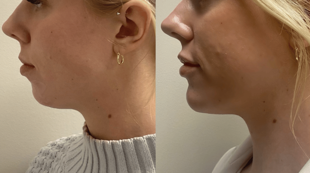 restalyne filler for non surgical double chin reduction treatment