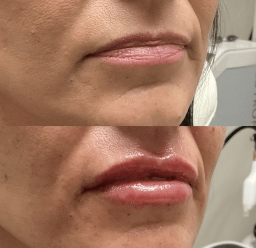 lip injections patient results