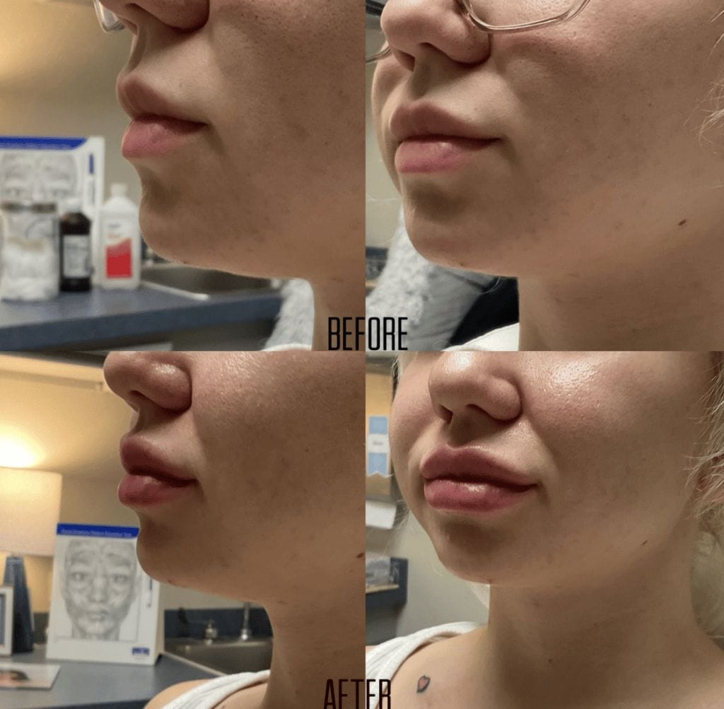 progression of lip filler done to a female patient