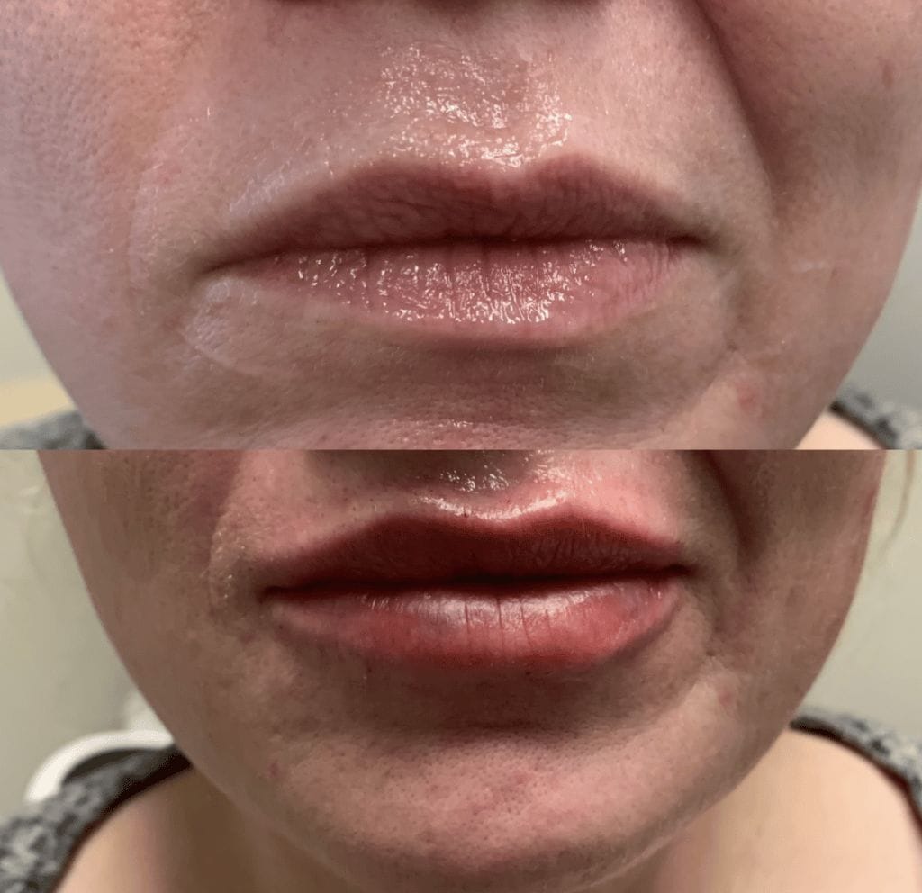 lip flip injections plainfield