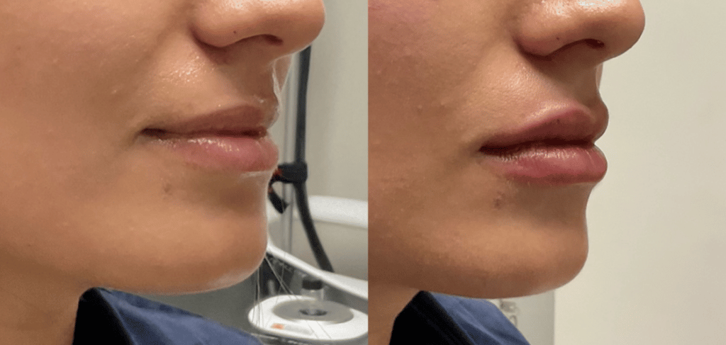 lip flip injections joliet