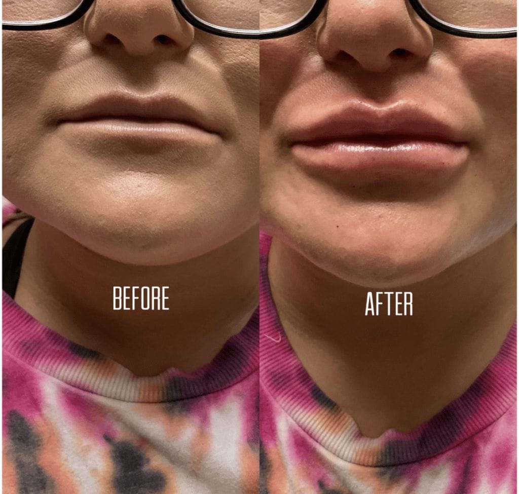 injections for fuller lips