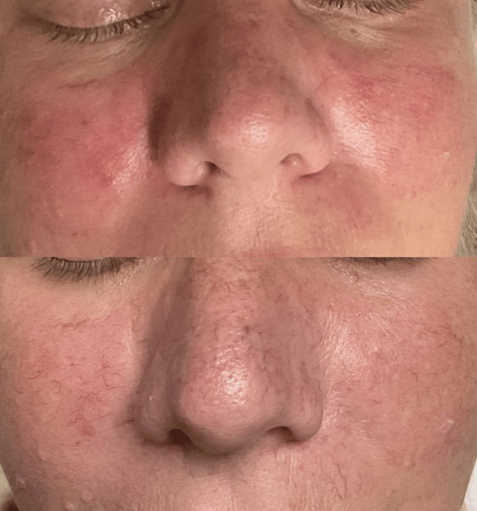 laser treatment for veins on face