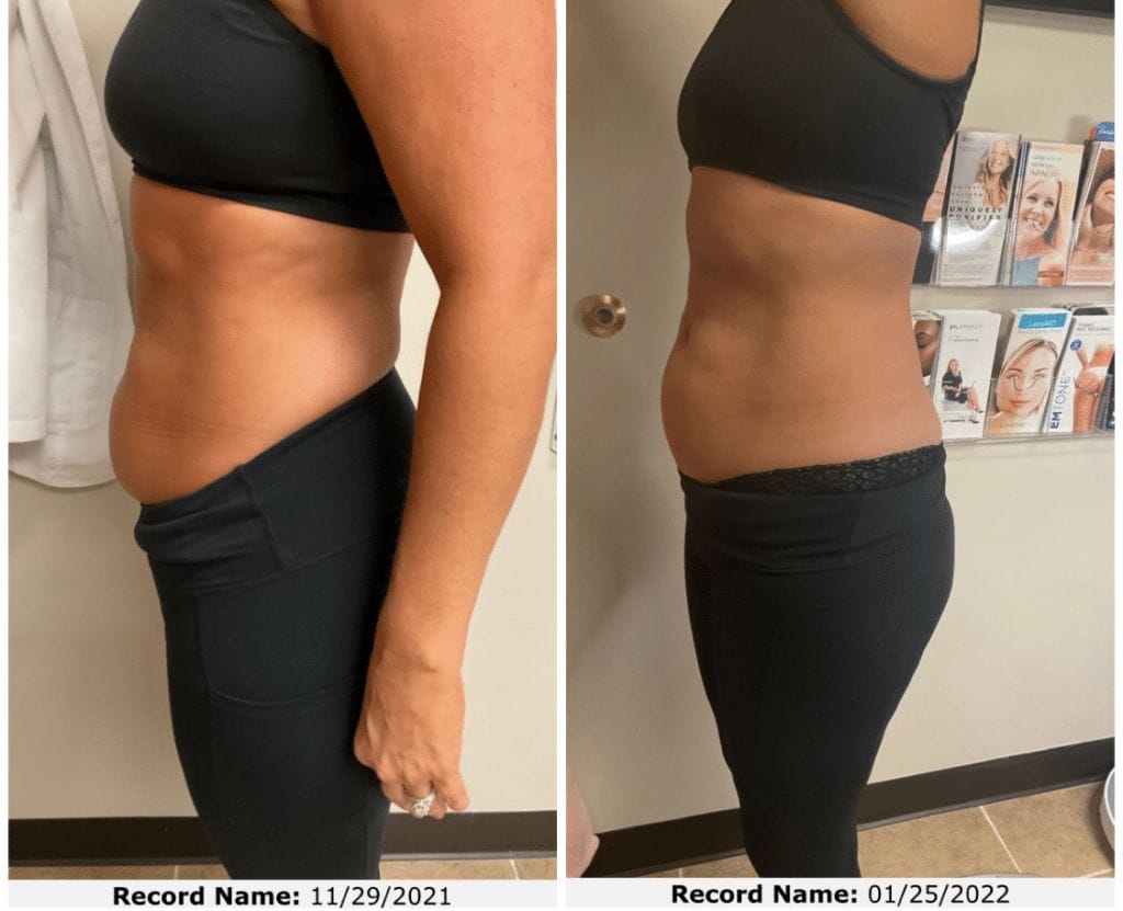 laser to reduce stomach fat