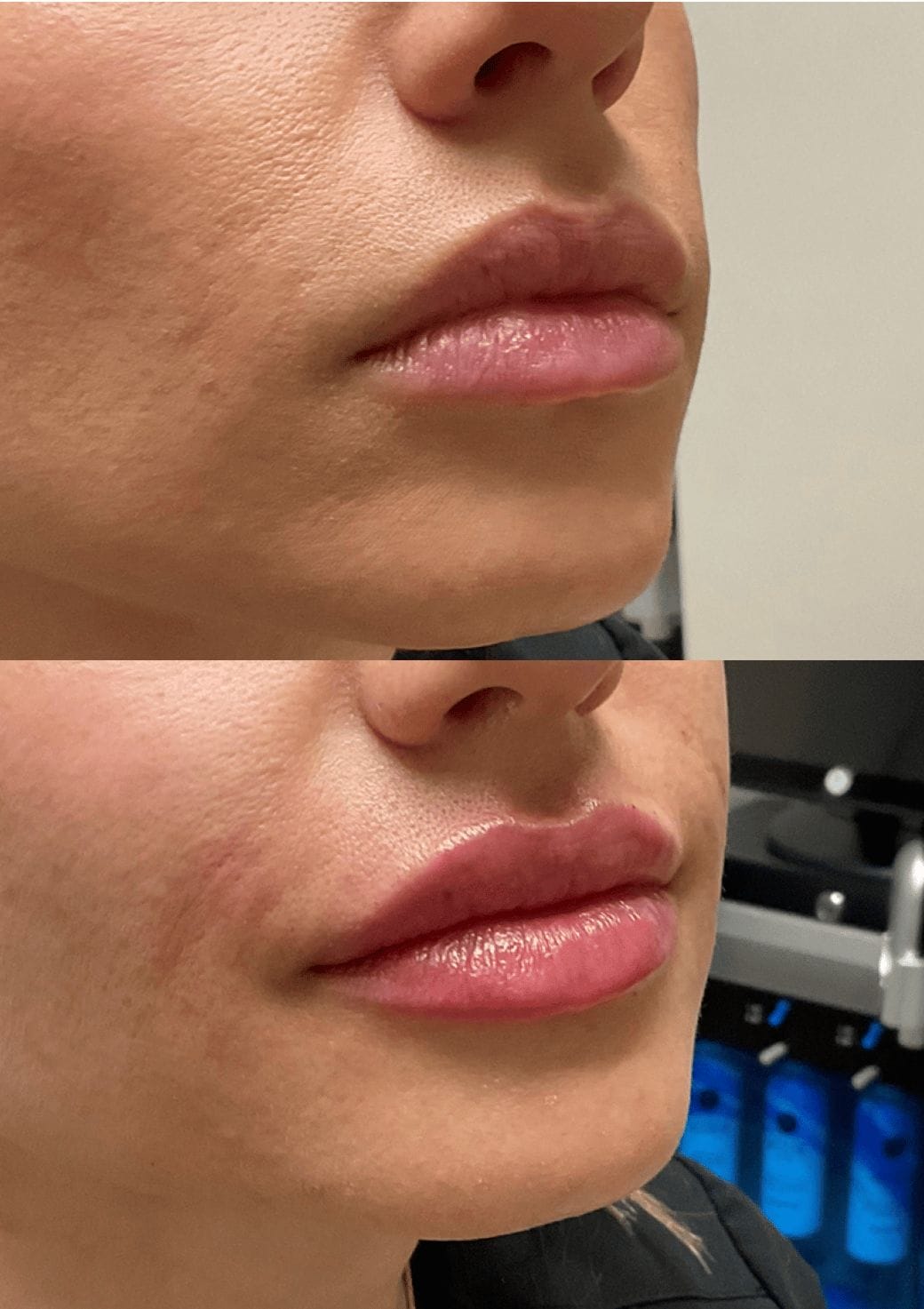 Microneedling