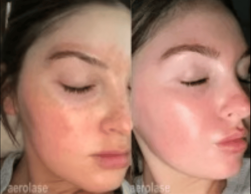aerolase laser to address patient's issues with skin texture and enlarged pores