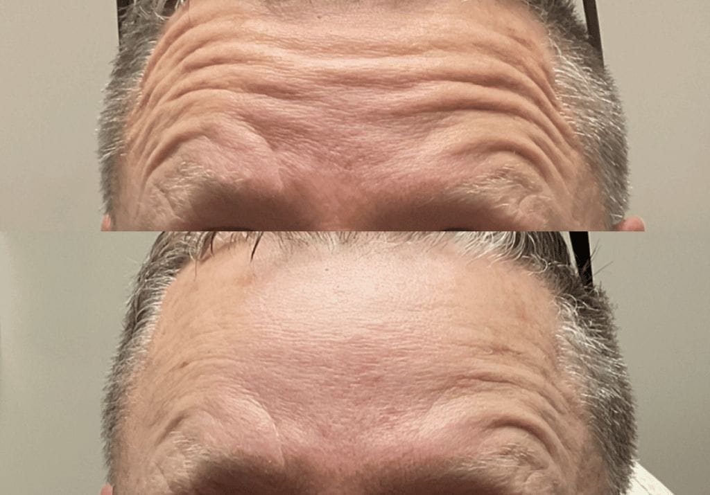 botox injection for forehead lines
