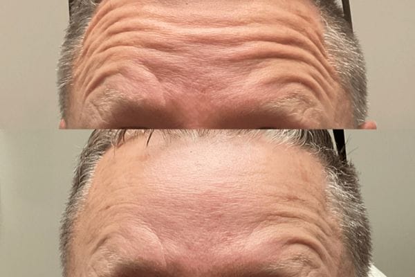 botox treatment near plainfield il for forehead lines