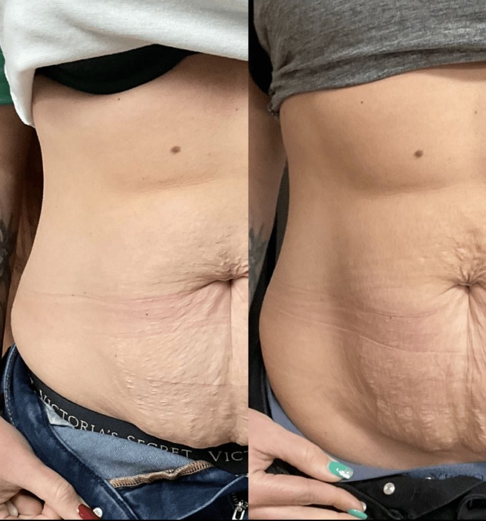 laser c section plainfield illinois