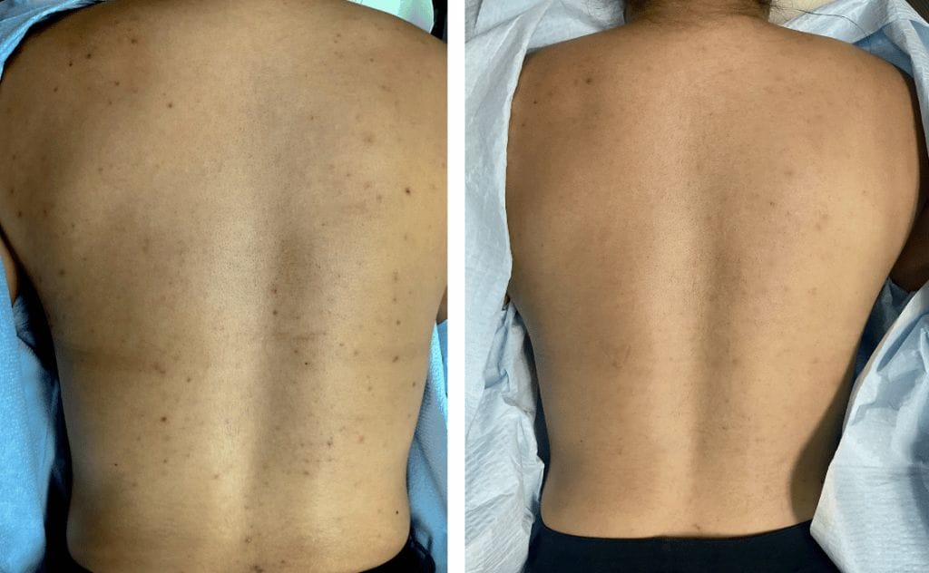 back acne laser treatment