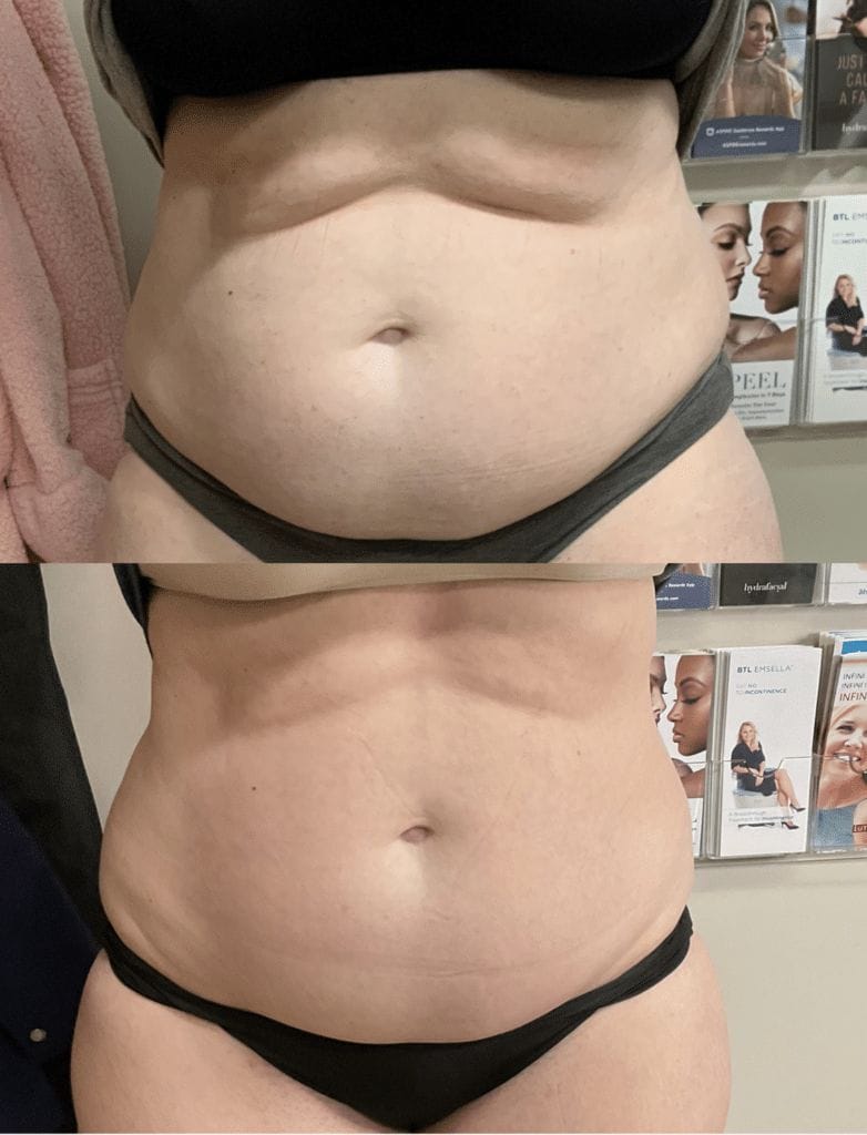 stomach toning with laser