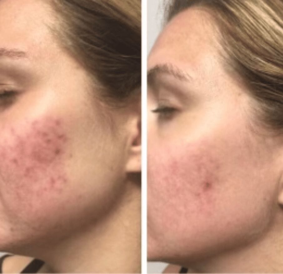 acne spa treatment joliet illinois
