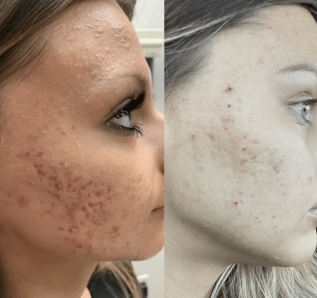 restoring skin from post acne scars