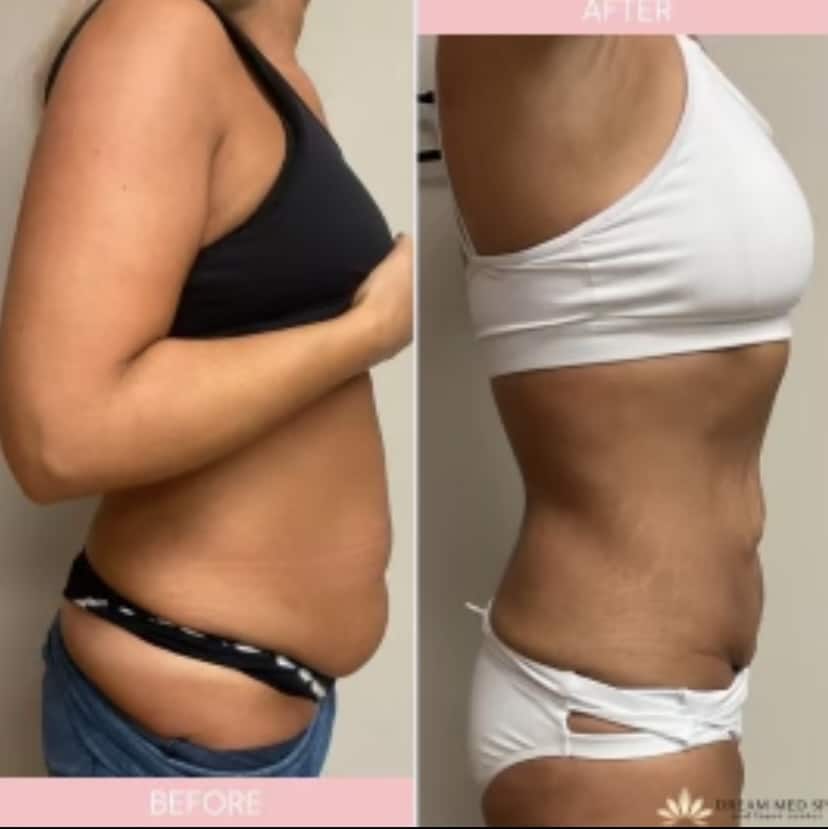 stomach tightening laser