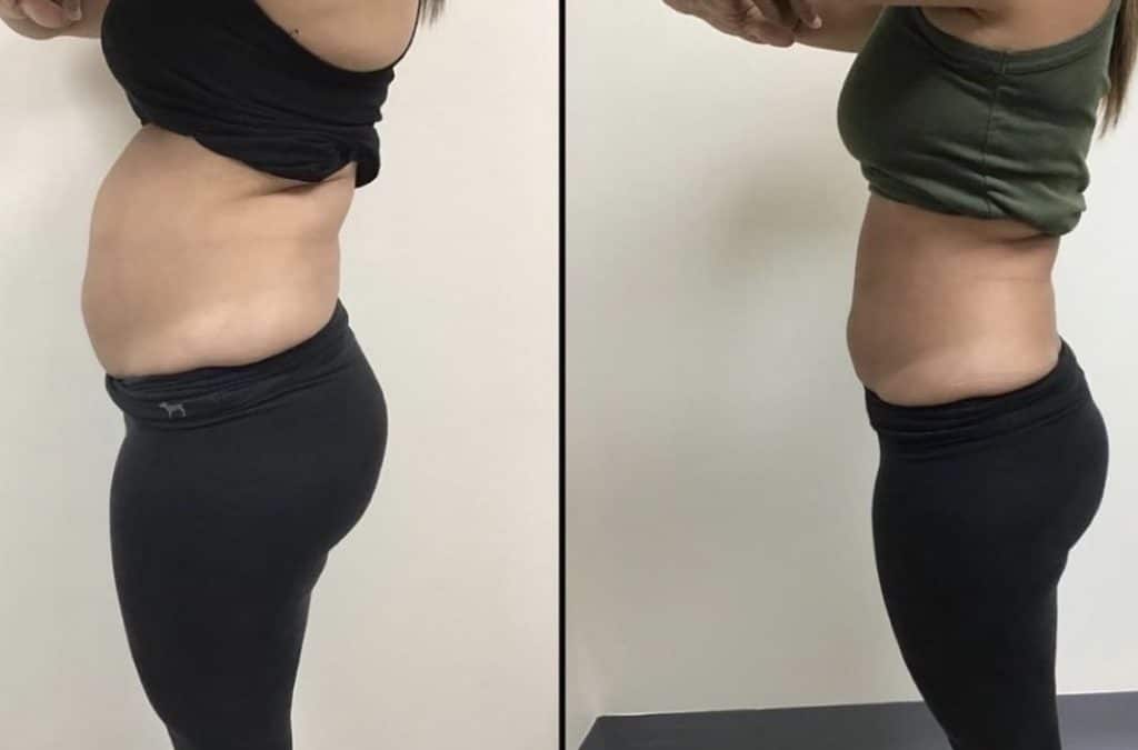 non surgical fat removal from stomach