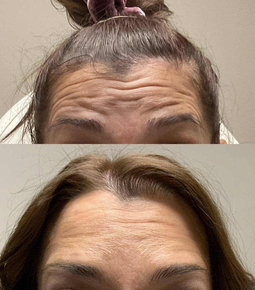 botox near plainfield il