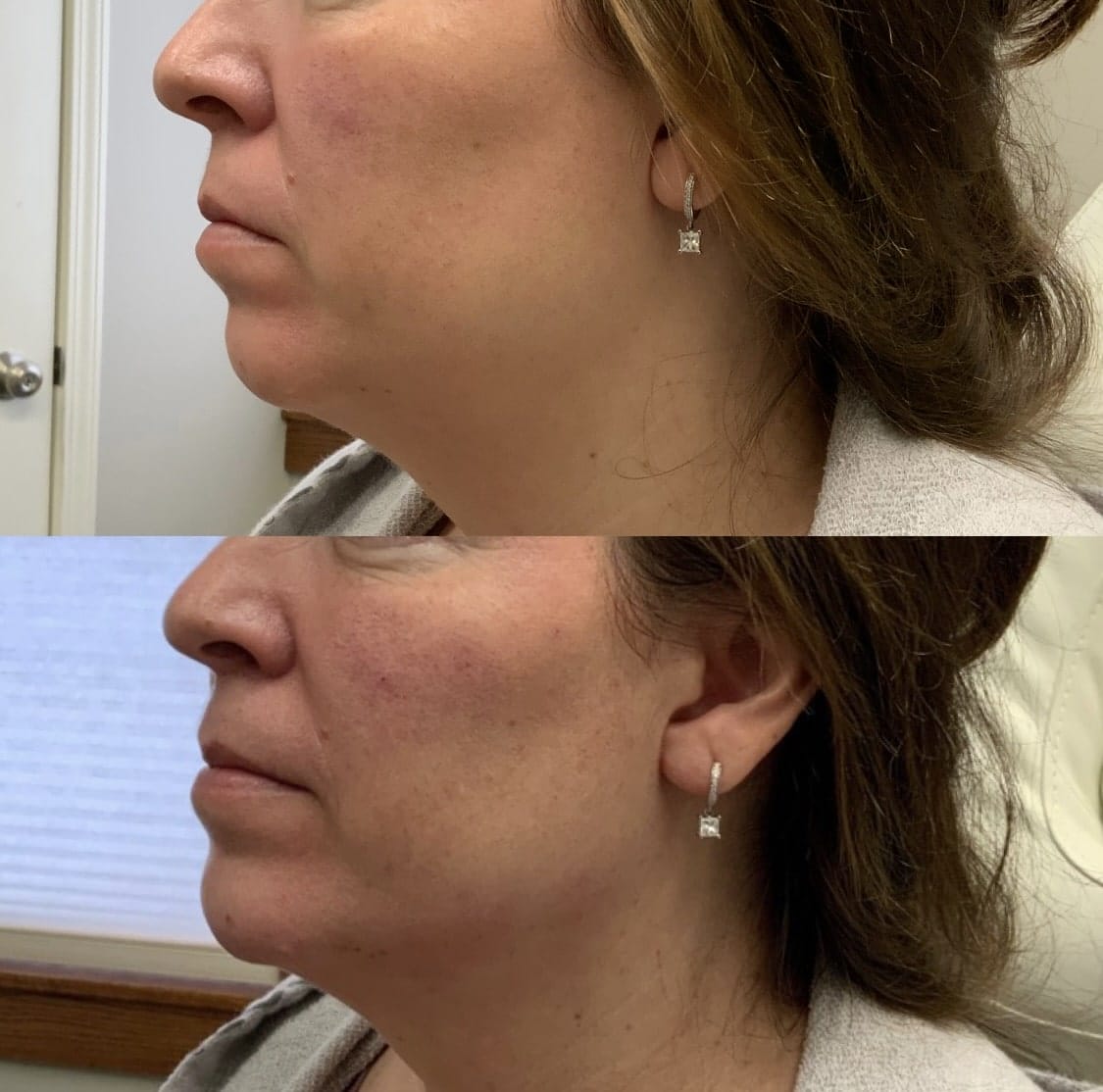 how to get rid of double chin without surgery