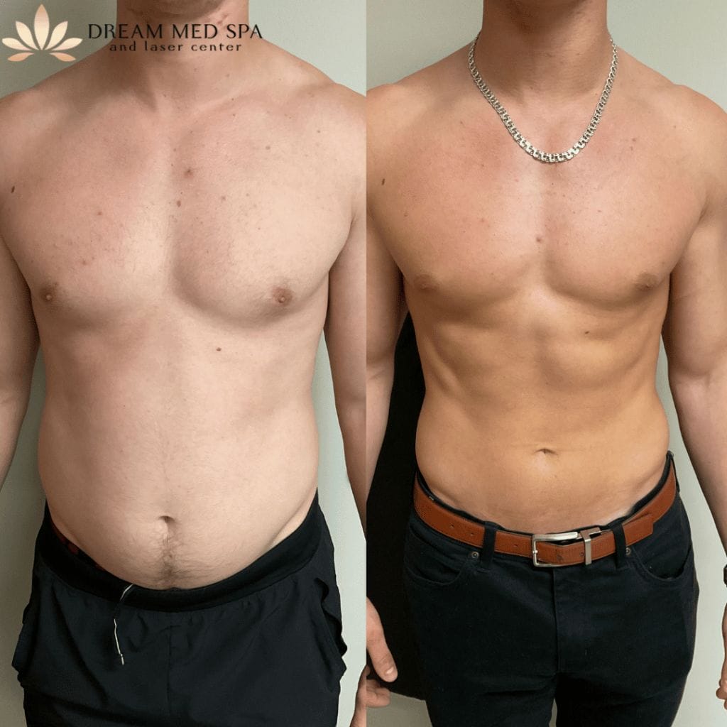 non invasive body contouring