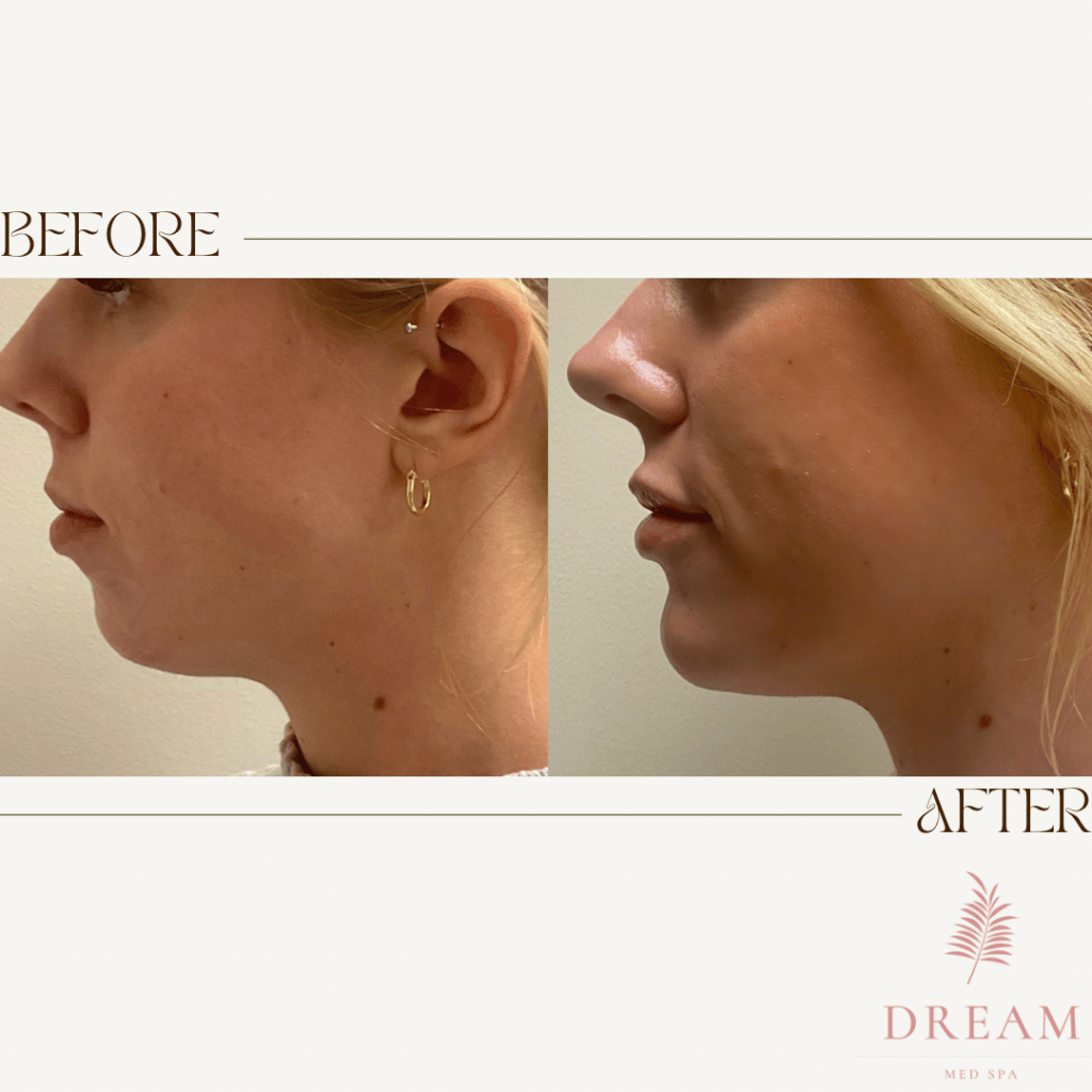 patient results from a non surgical double chin removal