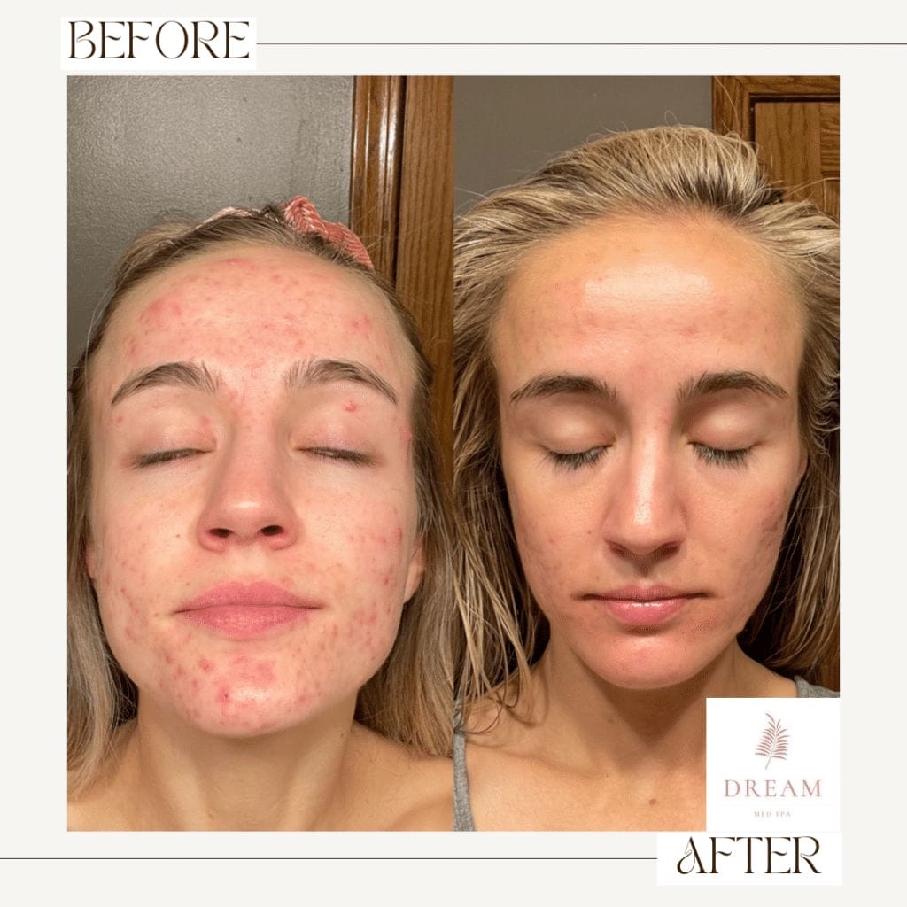 laser treatment for acne scars removal