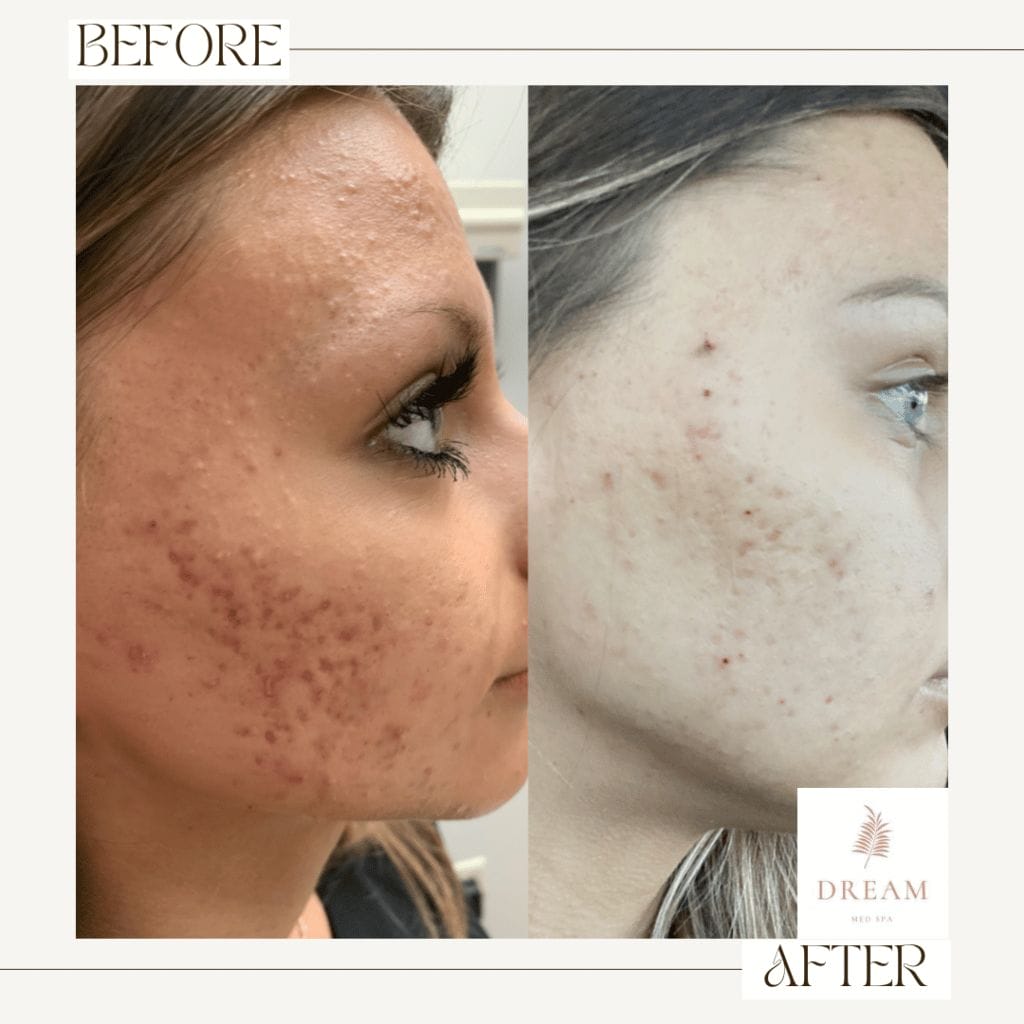 before and after of patient after receiving custom skin care to address her hyperpigmentation