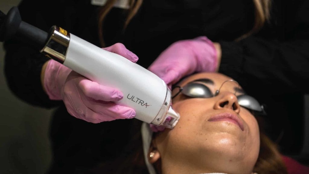 removing sun damage from the patient's face with the LaseMD laser