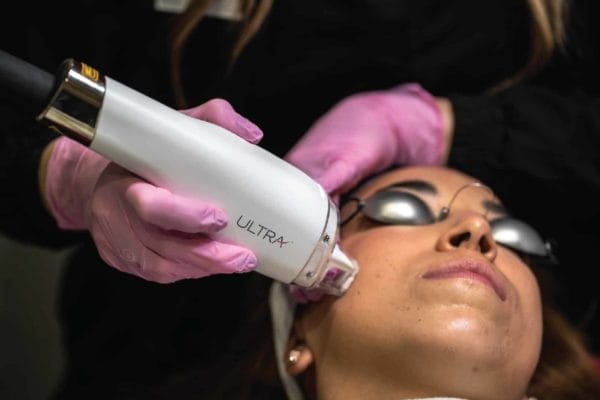 removing sun damage from the patient's face with the LaseMD laser