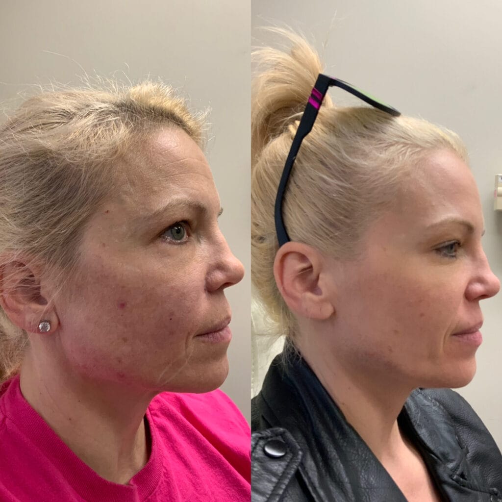 Facial rejuvenation with Sculptra, Botox, and filler combination