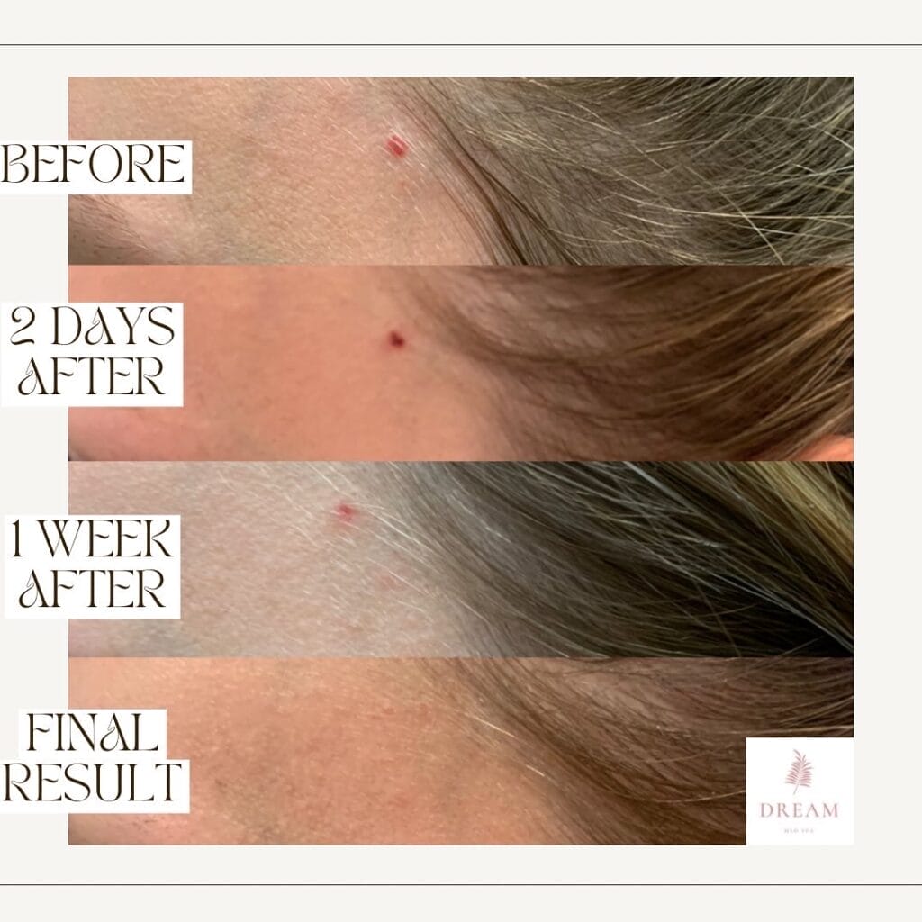 patient after receiving treatment with the Aerolase NeoElite to remove a cherry angioma on the side of her face