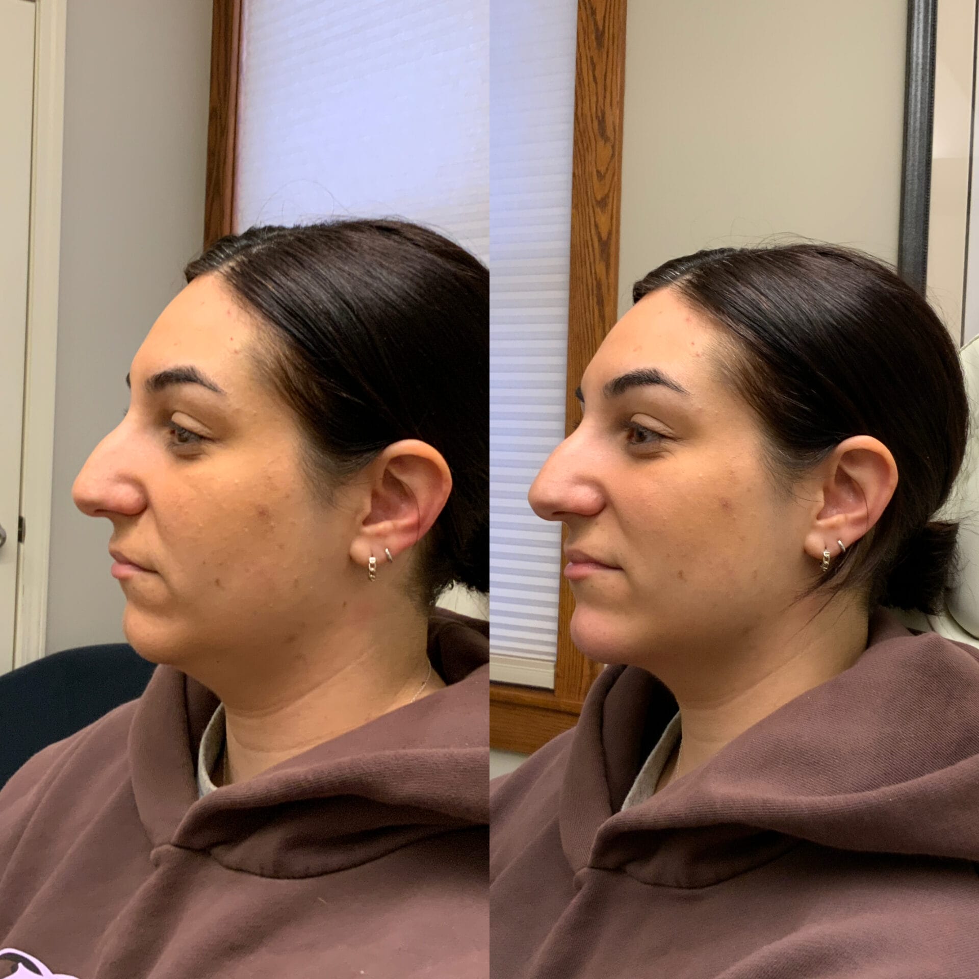 Chin filler treatment results showing enhanced profile