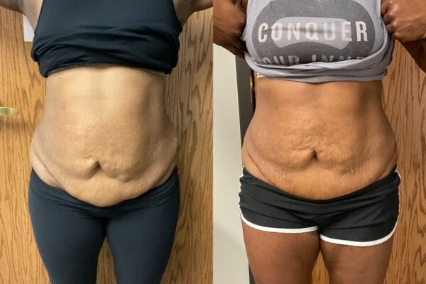 patient with firmer stomach after getting emsculpt neo treatment