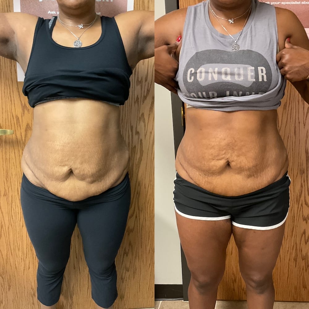 patient with firmer stomach after getting emsculpt neo treatment