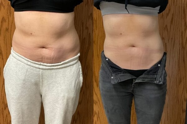 Before and after Emsculpt Neo treatment for abdomen definition