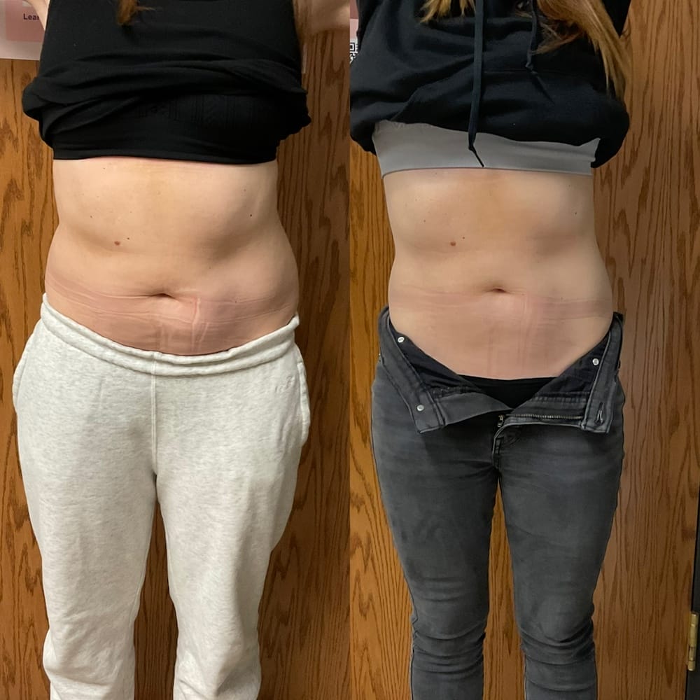 Before and after Emsculpt Neo treatment for abdomen definition